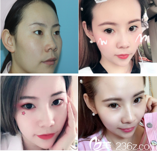 青島壹美整形醫(yī)院埋線雙眼皮手術(shù)案例