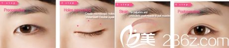 青島壹美整形醫(yī)院韓式微創(chuàng)三點(diǎn)定位雙眼皮
