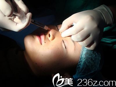 玻尿酸填充鼻子