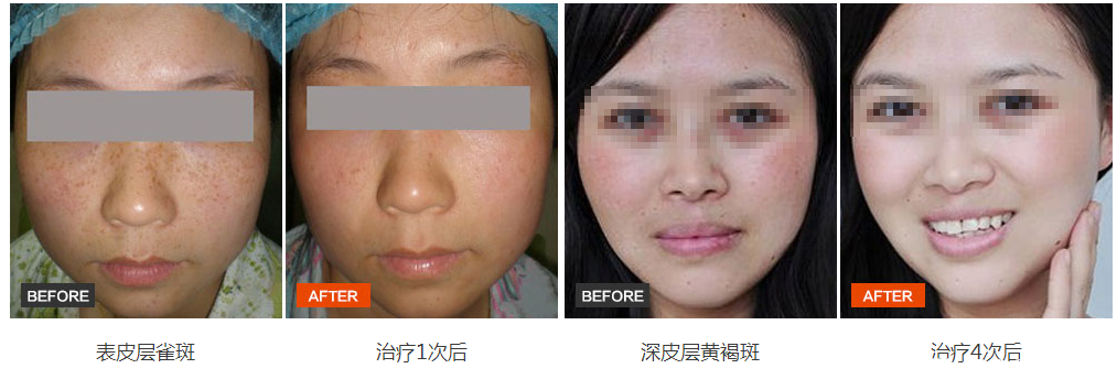 祛斑案例