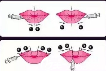 玻尿酸豐唇的過程