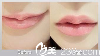玻尿酸豐唇的前后對比
