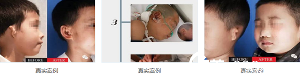 康春雨小耳再造真實(shí)案例