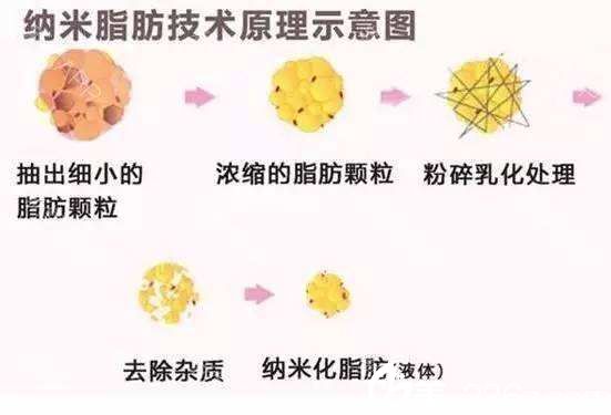 納米脂肪填充改善黑眼圈
