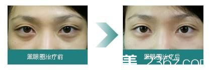 治療黑眼圈真人案例