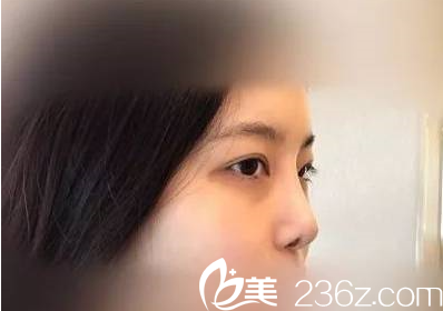 南京維多利亞做整形效果好嗎真人案例