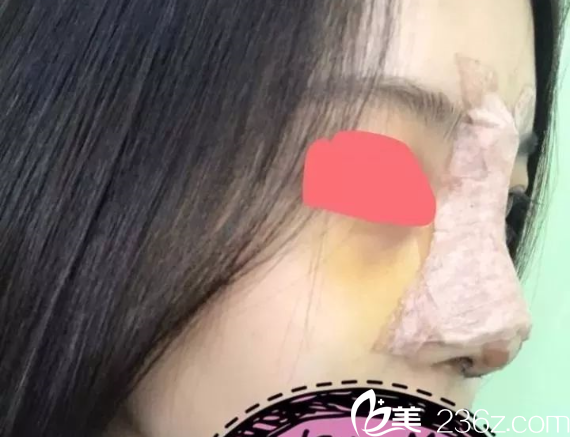 南京維多利亞隆鼻開(kāi)眼角術(shù)后3天