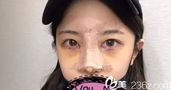 隆鼻開(kāi)眼角術(shù)后5天