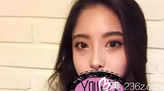 南京維多利亞開(kāi)眼角術(shù)后2個(gè)月