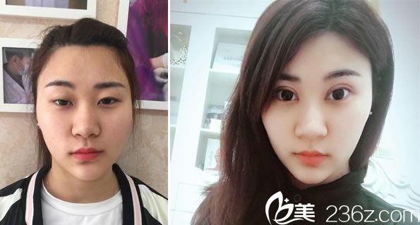 趙學(xué)燕醫(yī)生做雙眼皮怎么樣