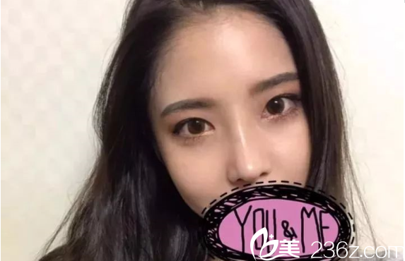 南京維多利亞隆鼻開(kāi)眼角真人案例