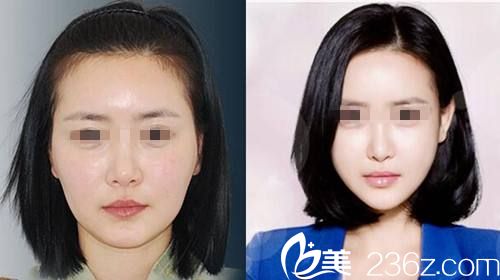 韓國(guó)一見(jiàn)整形外科醫(yī)院案例