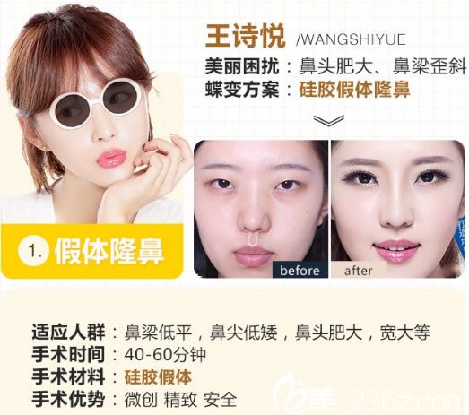 嘉興禾美硅膠假體隆鼻案例