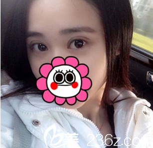 太原歐美蓮全切雙眼皮案例術(shù)后2個(gè)月效果