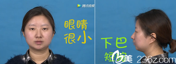 <!--<i data=20240703-sp></i>-->柏羽高亮雙眼皮+假體隆下巴術(shù)前照 <!--<i data=20240703-sp></i>-->柏羽高亮雙眼皮+假體隆下巴術(shù)前照