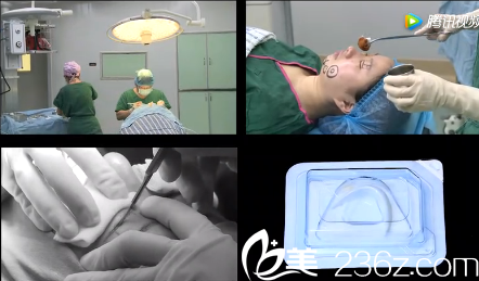 高亮美杜莎雙眼皮+假體隆頦手術(shù) 高亮美杜莎雙眼皮+假體隆頦手術(shù)