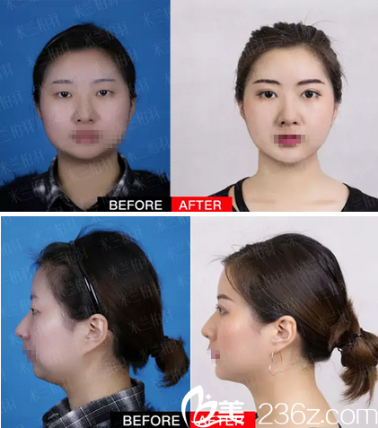 <!--<i data=20240703-sp></i>-->柏羽高亮雙眼皮+假體隆頦手術(shù)對比照 <!--<i data=20240703-sp></i>-->柏羽高亮雙眼皮+假體隆頦手術(shù)對比照