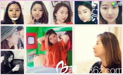 美杜莎雙眼皮+假體隆頦術(shù)后恢復(fù) 美杜莎雙眼皮+假體隆頦術(shù)后恢復(fù)