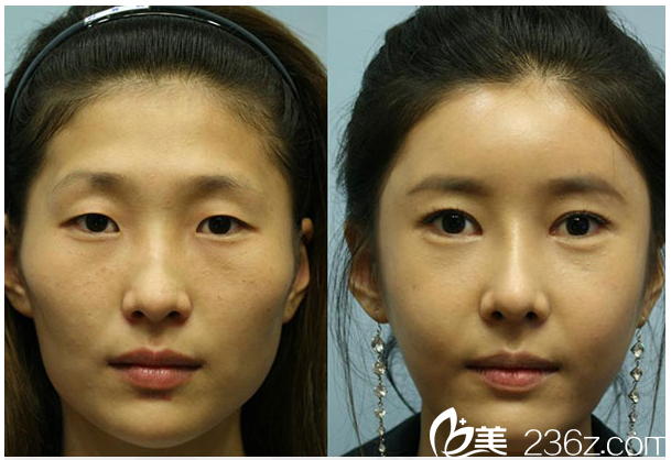 廣州紫馨曹仁昌自體脂肪填充+雙眼皮+隆鼻案例 廣州紫馨曹仁昌自體脂肪填充+雙眼皮+隆鼻案例