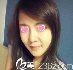 鼻綜合手術(shù)15天鼻子慢慢恢復(fù)中 鼻綜合手術(shù)15天鼻子慢慢恢復(fù)中