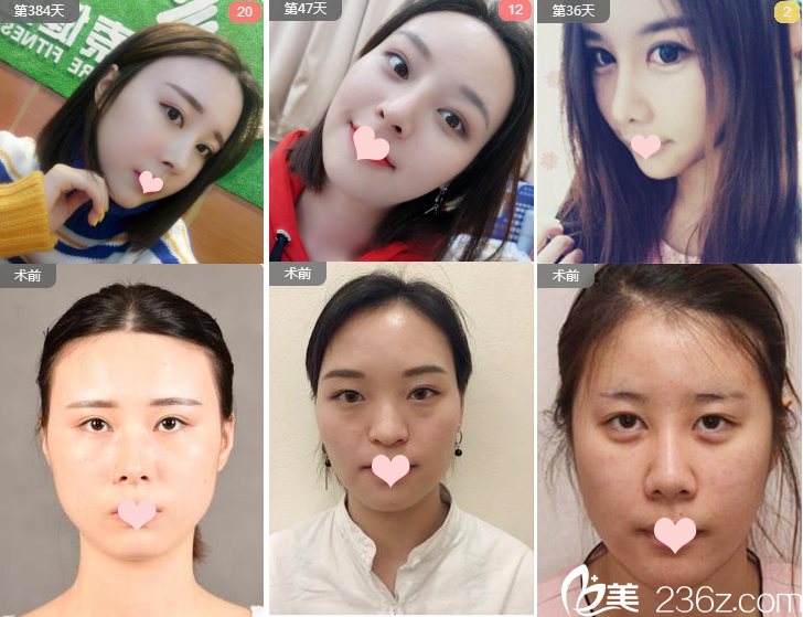 廣州華美整形醫(yī)院沈紹勇做過(guò)的隆鼻效果圖