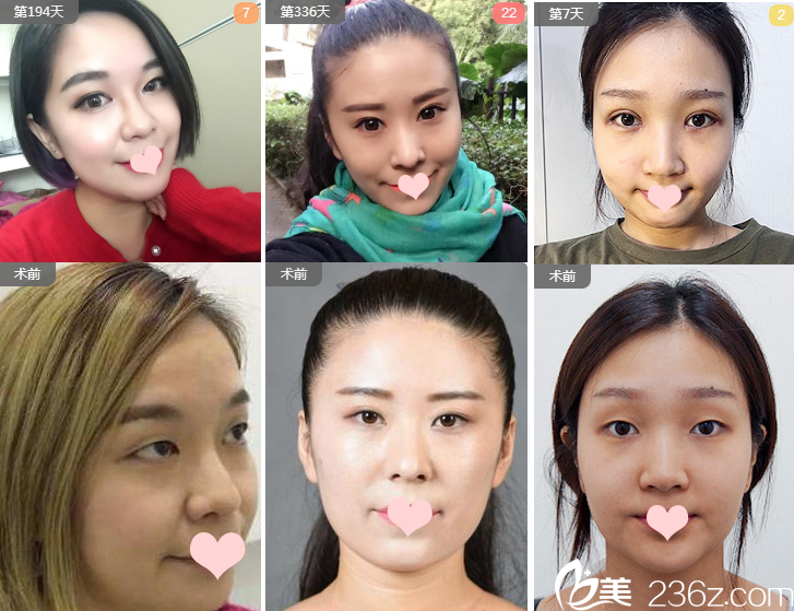 廣州華美阮慶玲做過的雙眼皮案例組圖 廣州華美阮慶玲做過的雙眼皮案例組圖