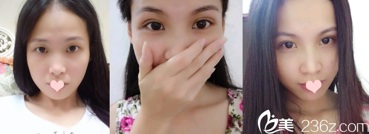 廣州華美王洪勇醫(yī)生雙眼皮案例對(duì)比圖