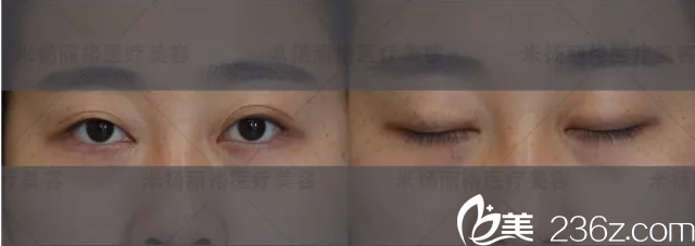 米揚(yáng)麗格求美者眼睛分析 米揚(yáng)麗格求美者眼睛分析