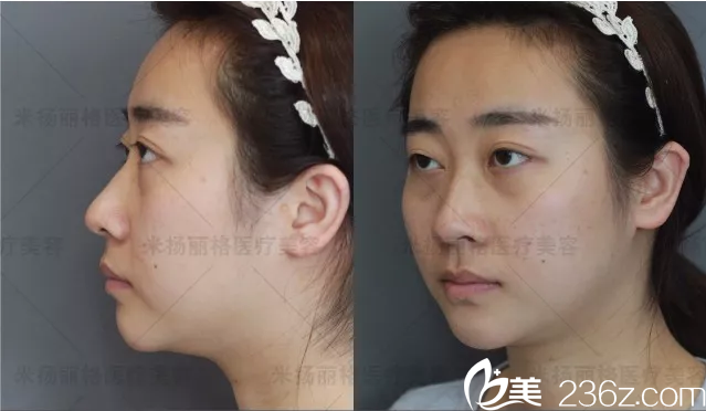 北京米揚(yáng)麗格求美案例分析 北京米揚(yáng)麗格求美案例分析