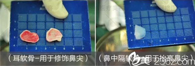 鼻綜合手術(shù)方案 鼻綜合手術(shù)方案