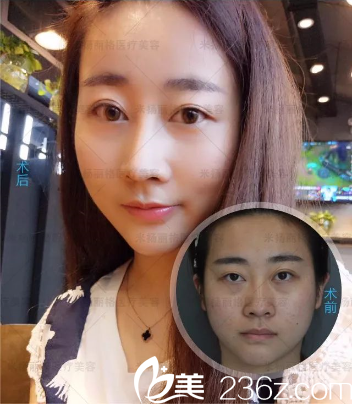 北京米揚(yáng)麗格真人案例術(shù)后改變 北京米揚(yáng)麗格真人案例術(shù)后改變
