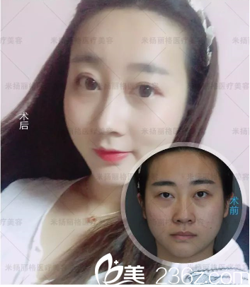北京米揚(yáng)麗格全臉填充加隆鼻真人案例