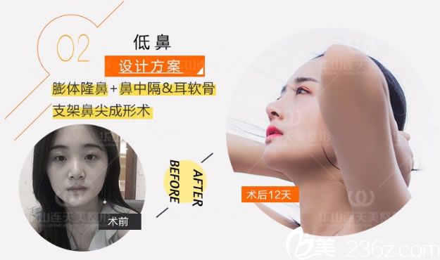 冷奎仿醫(yī)生做的鼻整形案例 冷奎仿醫(yī)生做的鼻整形案例