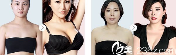 盛飛醫(yī)生隆胸手術案例 盛飛醫(yī)生隆胸手術案例