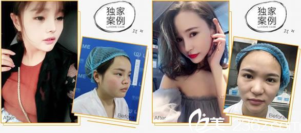 <!--<i data=20240703-sp></i>-->醫(yī)生的鼻綜合整形案例 <!--<i data=20240703-sp></i>-->醫(yī)生的鼻綜合整形案例