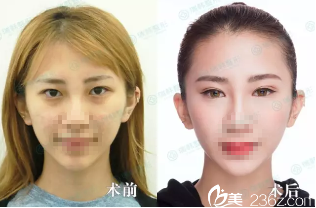 海南瑞韓雙眼皮案例 海南瑞韓雙眼皮案例