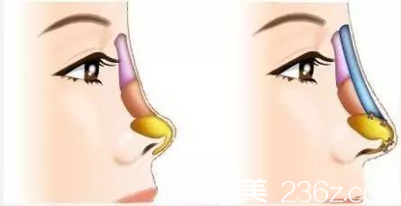 隆鼻只是簡單的墊高鼻子？