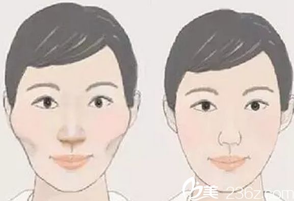 做顴骨整形哪家醫(yī)院好？北京做顴骨整形好的醫(yī)院