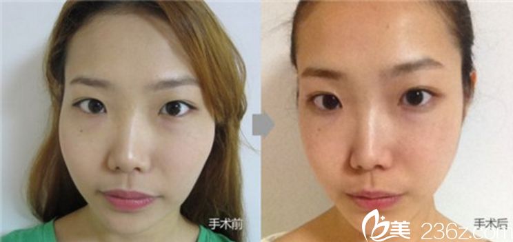 顴骨整形前后對比