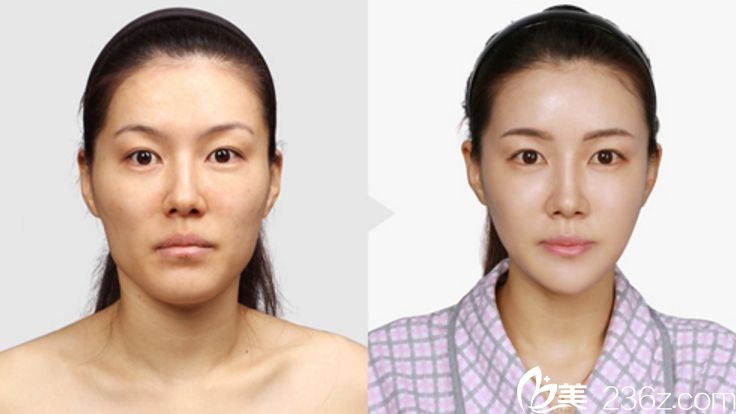 韓國顴骨降低哪家醫(yī)院好