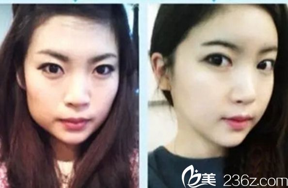 做顴骨整形哪家醫(yī)院好？北京做顴骨整形好的醫(yī)院