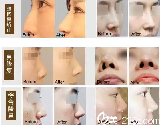 隆鼻案例 隆鼻案例