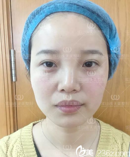 注射玻尿酸即刻效果圖