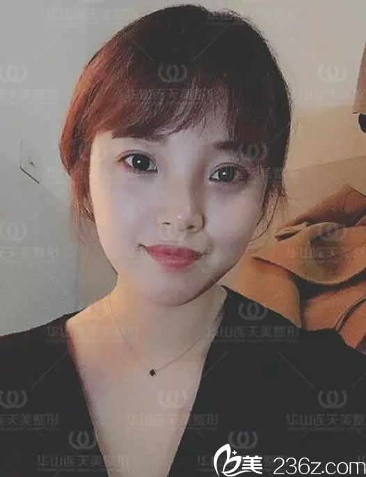 瘦臉一周的變化效果