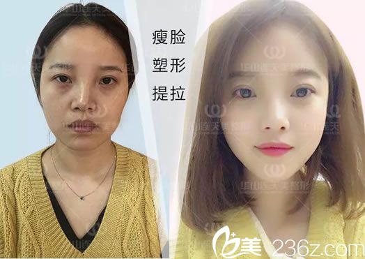 注射瘦臉前后效果對比照