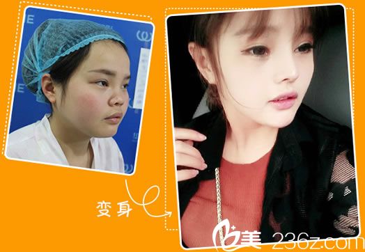 華派美鼻案例效果圖 華派美鼻案例效果圖
