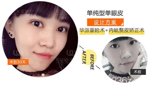 華派美眼術(shù)案例效果圖 華派美眼術(shù)案例效果圖