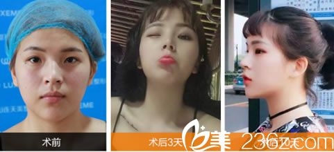 <!--<i data=20240703-sp></i>-->醫(yī)生注射玻尿酸填充效果