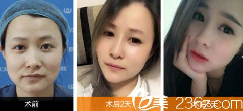 <!--<i data=20240703-sp></i>-->醫(yī)生注射玻尿酸隆鼻案例圖