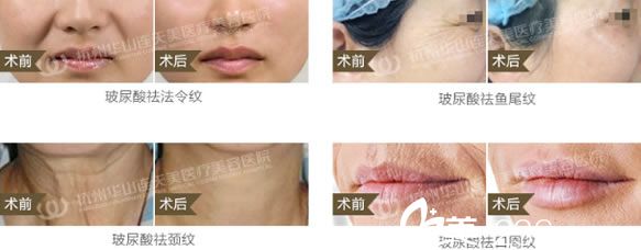 柳春紅醫(yī)生注射玻尿酸除皺效果 柳春紅醫(yī)生注射玻尿酸除皺效果